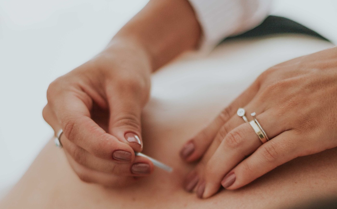 Acupuncturist placing a needle in a patient's upper back